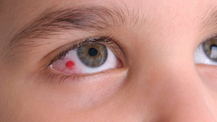 person-with-pink-eye-780x439