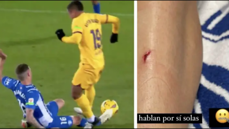 Mbrojtësi i Alaves publikon pamjet e këmbës së tij pasi u shkel nga Vitor Roque Mbrojtësi i Alaves publikon pamjet e këmbës së tij pasi u shkel nga Vitor Roque